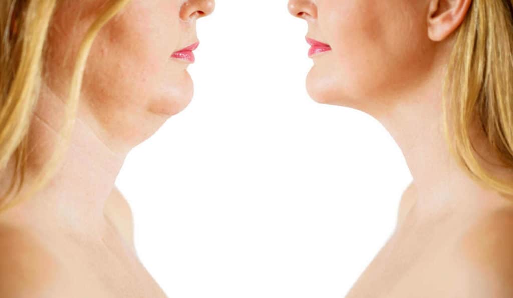Double Chin treatment Brackley before and after results