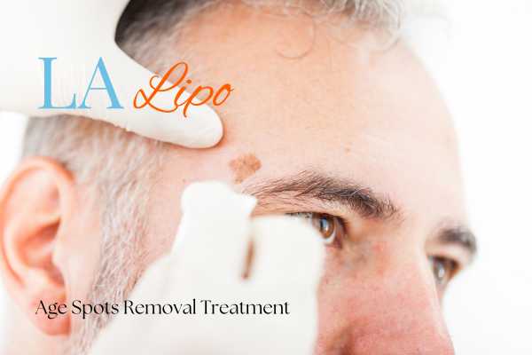 What Are the Most Effective Treatments for Age Spots Brackley?