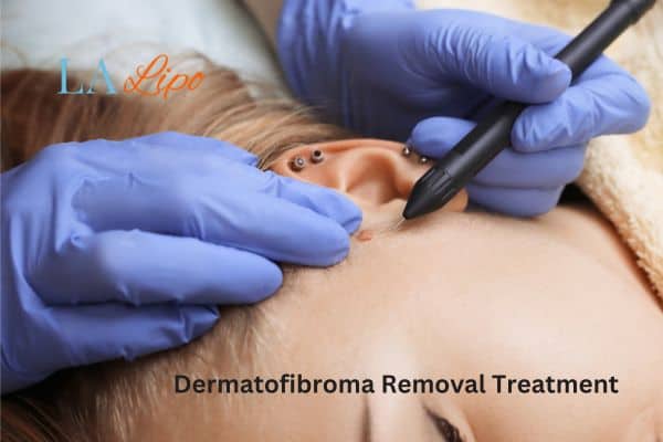 Dermatofibroma Removal Treatment Brackley