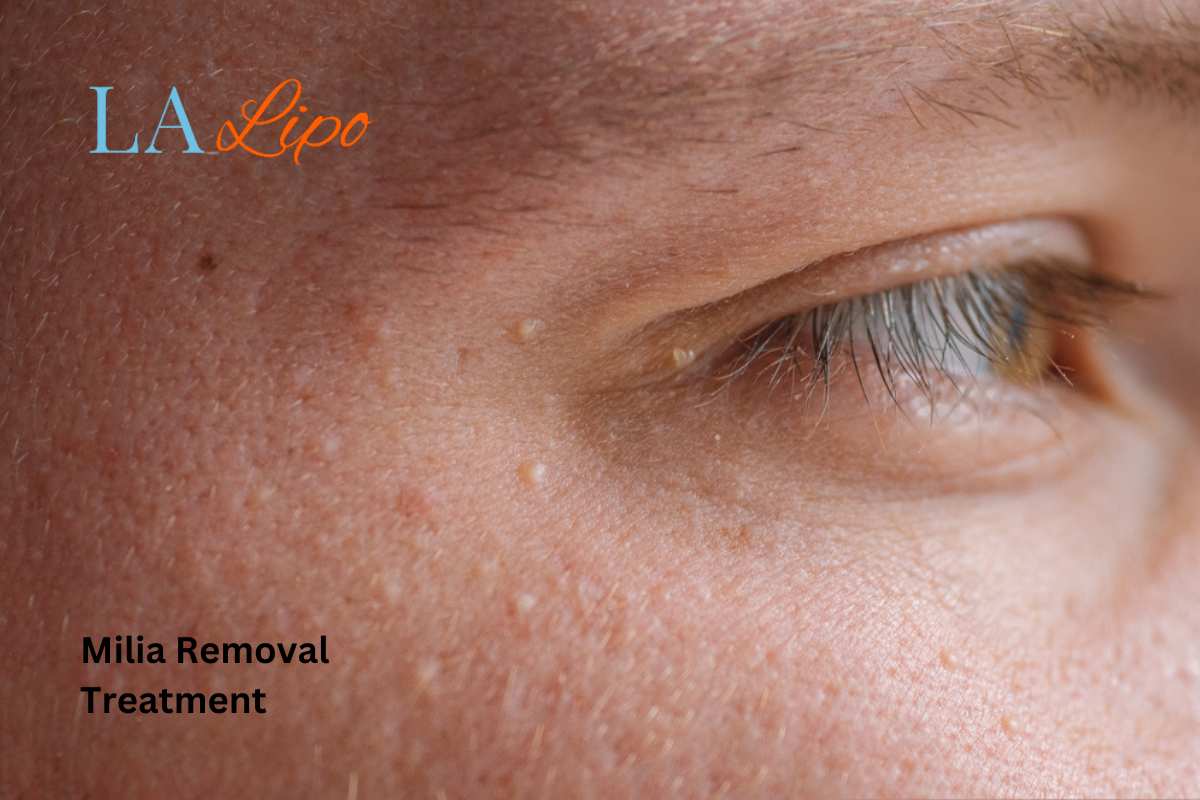 Cryopen Milia Removal: Is It the Easiest and Safest Option Brackley?