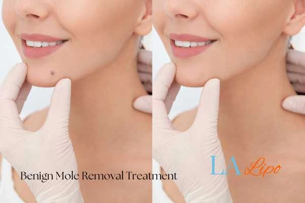 woman's before and after mole removal Brackley results