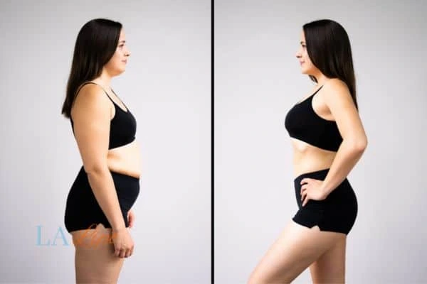 image of woman before and after results of LA-EMS Body Sculpting Brackley to help treat Diastasis recti