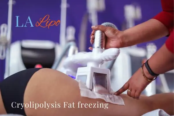 women getting fat freezing Brackley