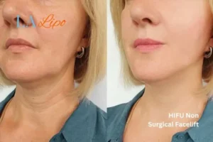 hi-fu for wrinkles Brackley before and after results