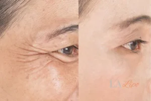 Before and after results of woman - HI-fu wrinkles reduction treatment Brackley