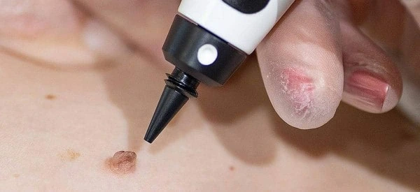 skin tag removal using cryopen Brackley