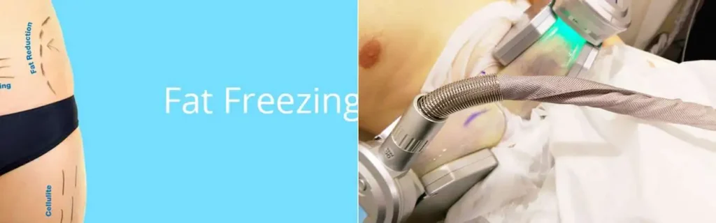 Fat freezing Brackley on multiple areas of the body