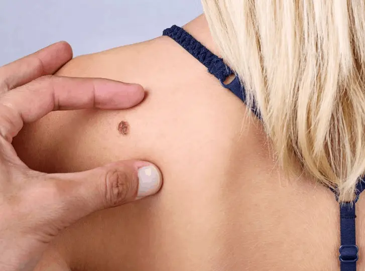woman having mole removal Brackley consultation before treatment.