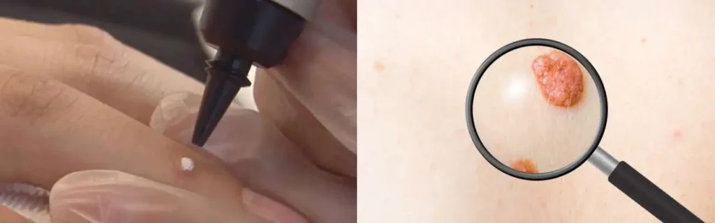 Cryopen for mole removal Brackley - speak to our team today!