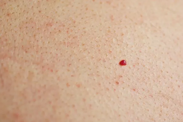 close up of a cherry angioma Brackley