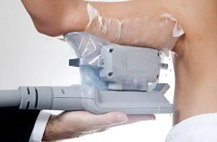 Picture of fat freezing Brackley on the upper arms.