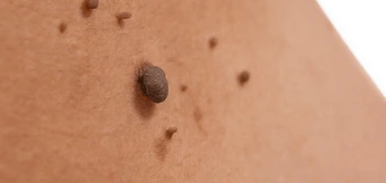 image of a skin tag Brackley