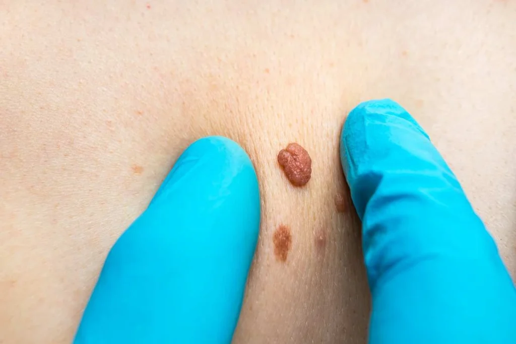 Consultant examining a skin tag Brackley