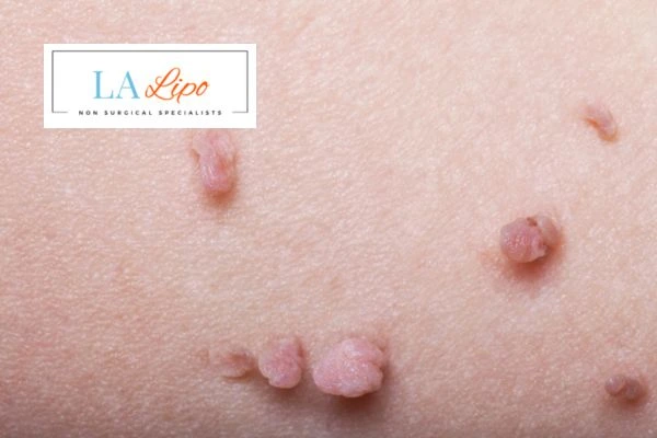 Does cryopen skin tag removal Brackley hurt? Find out now call our team today!