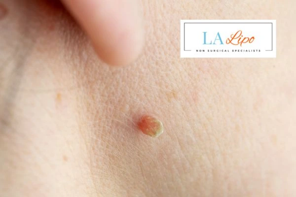 Book skin tag removal Brackley today speak to our team now!