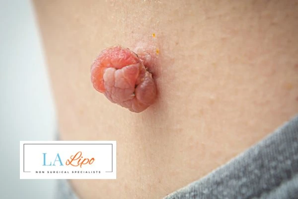Interested in skin tag removal Brackley? Concerned about the pain? Find out more today!
