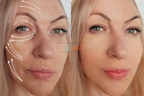 Morpheus 8 results Brackley face lift.