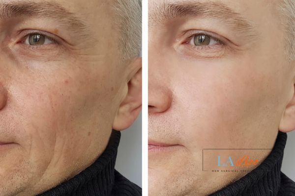 See the amazing results of Morpheus8 Treatment Brackley!