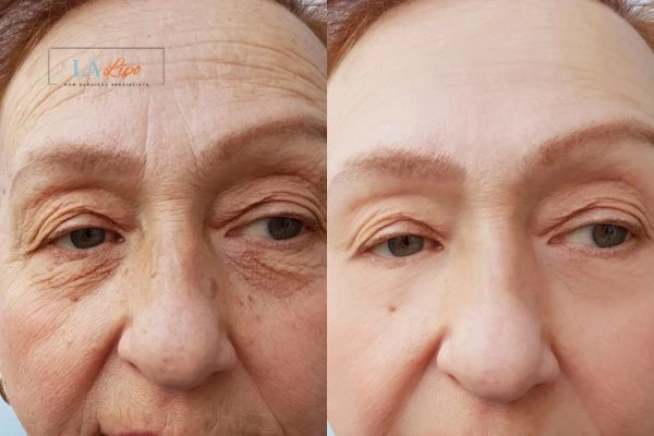 The powerful benefits of Morpheus8 Treatment Brackley - Call Our team today!