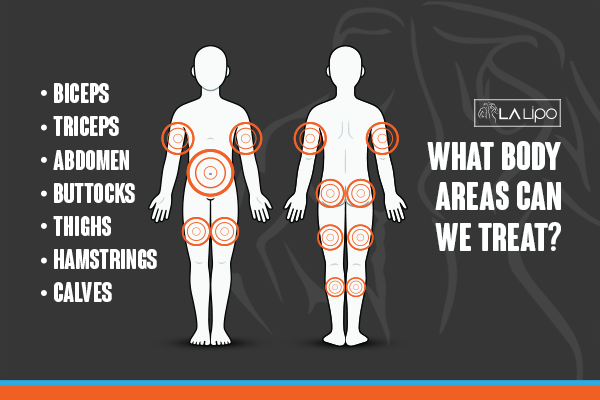 Diagram to show areas you can have LA-EMS Body Sculpting Treatment Brackley