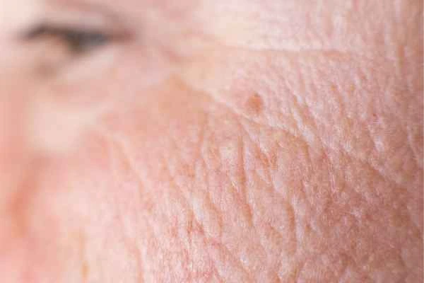 close up picture of a woman's face showing an age spot Brackley