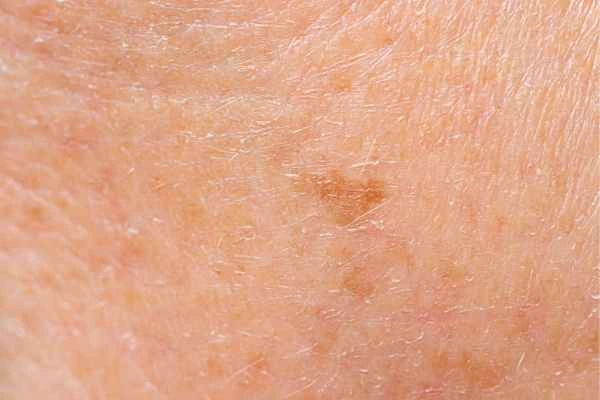 close up picture of age spots Brackley