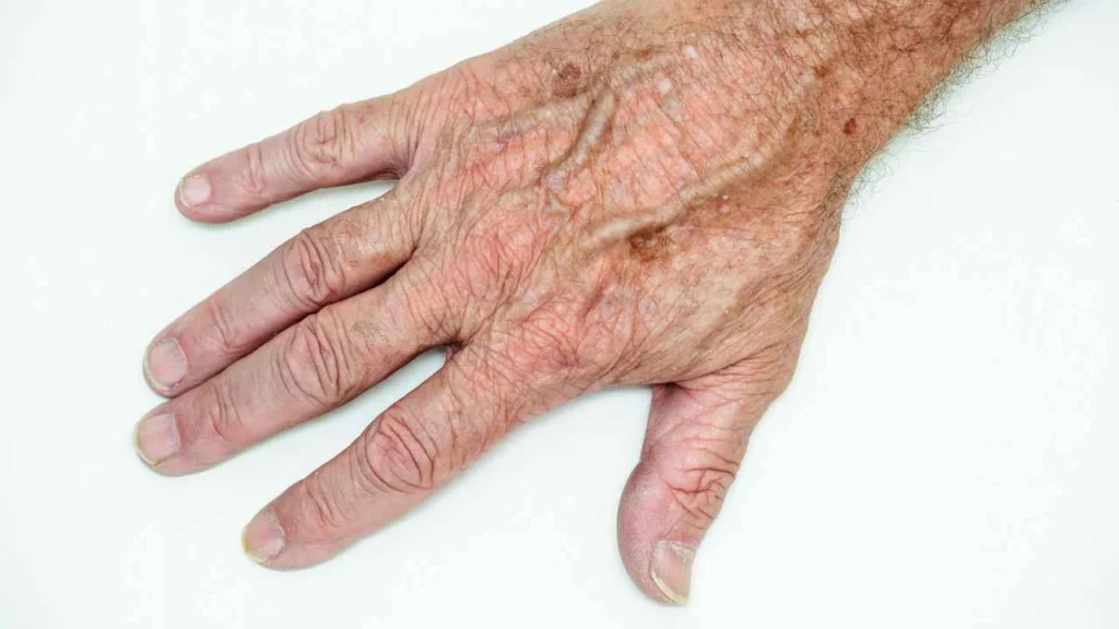 Male hand showing age spot Brackley