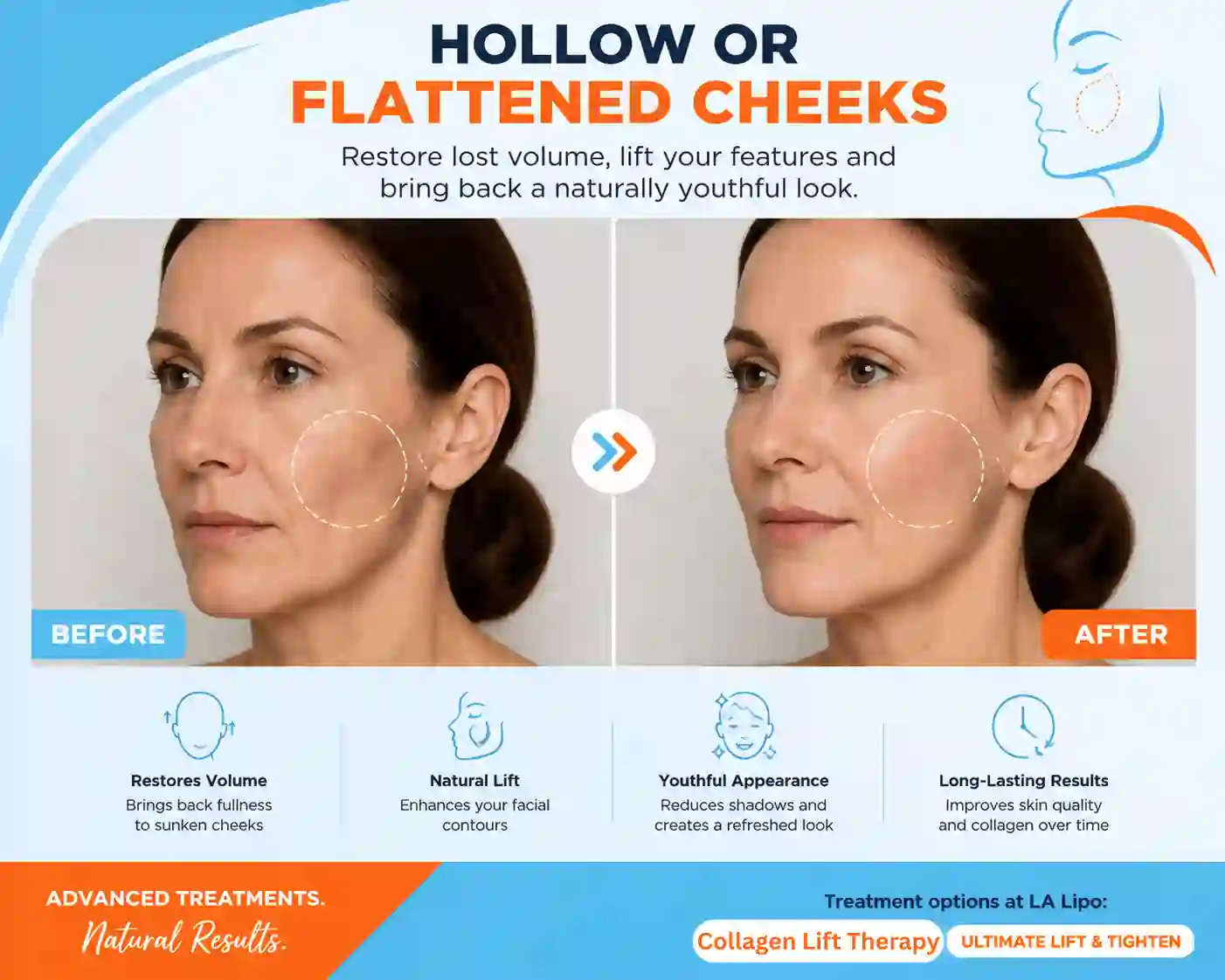 Sign #4: Hollow or Flattened Cheeks Brackley