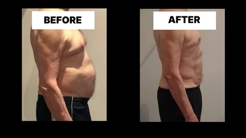 What Symptoms Can Diastasis Recti Cause in Men? Weak Core, Back Pain and Poor Posture Brackley